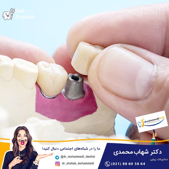 آیا ایمپلنت باعث سرطان می شود؟ - کلینیک دندانپزشکی دکتر شهاب محمدی